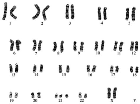 Alternativa a: cariótipo com pares numerados 1–22 e cromossomos sexuais; três elementos no grupo 21.