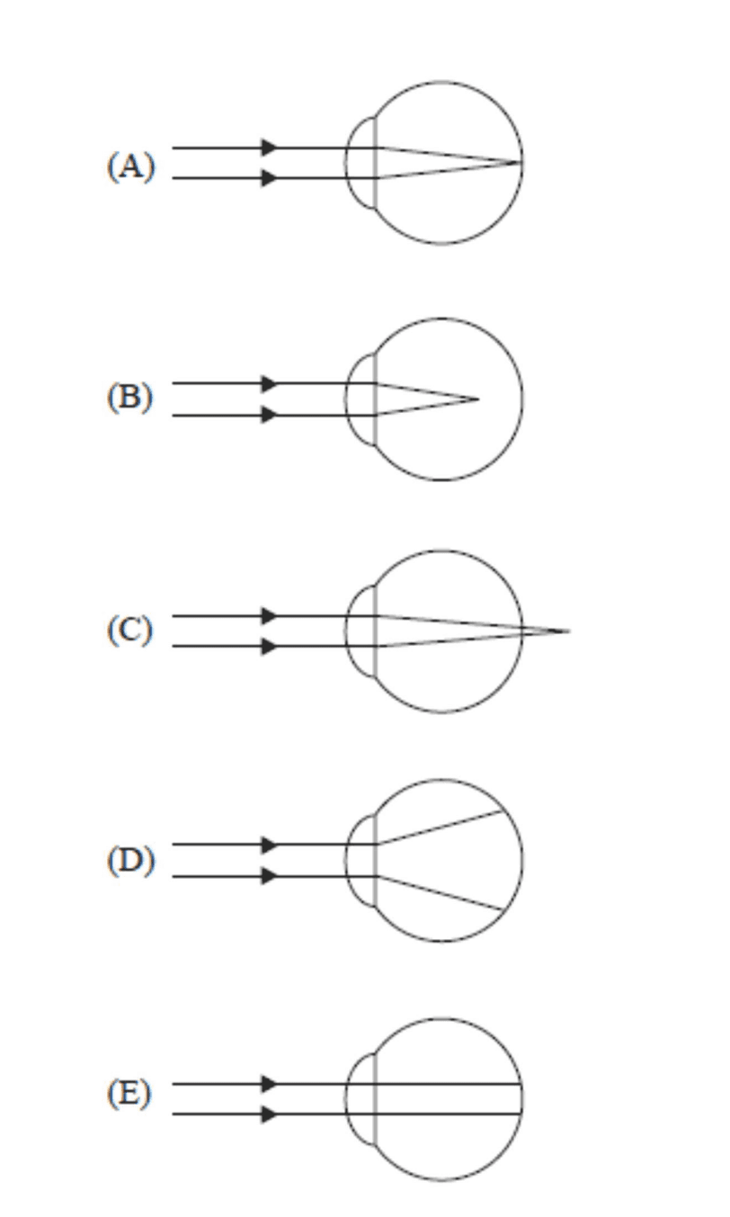 Cinco diagramas A a E de raios paralelos focalizados pelo olho.
